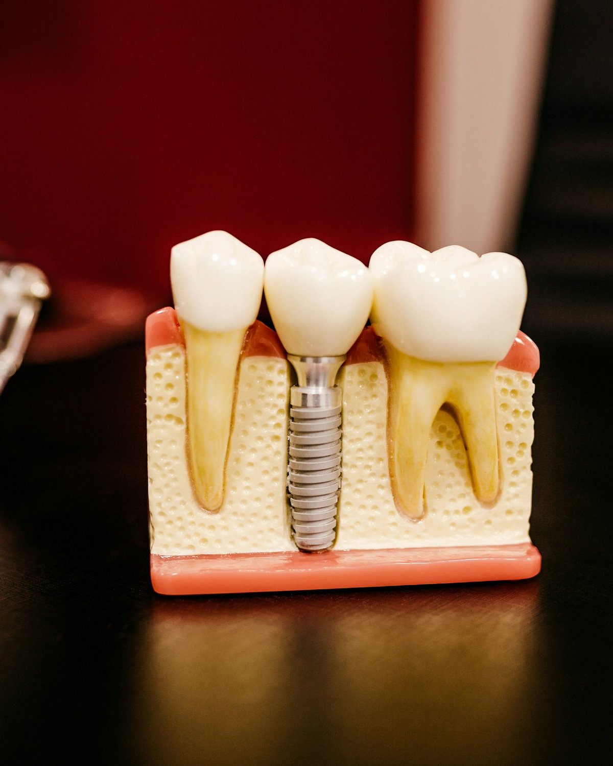 A model of a dental implant with a crown between two natural teeth